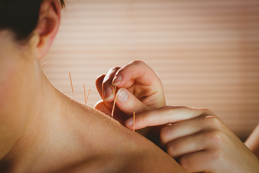 Acupuncture for Pain in Morristown
