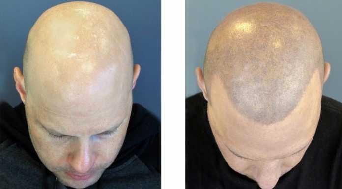 Scalp micro pigmentation