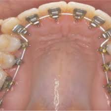 What types of orthodontics exist?