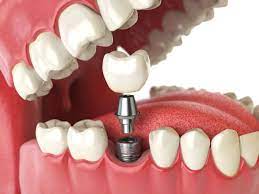 The Cost of Tooth Implants What Patients Can Expect to Pay