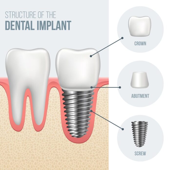 best dental implant clinic in dubai