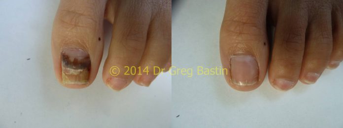 Cold Laser Technology in Nail Fungus Treatment