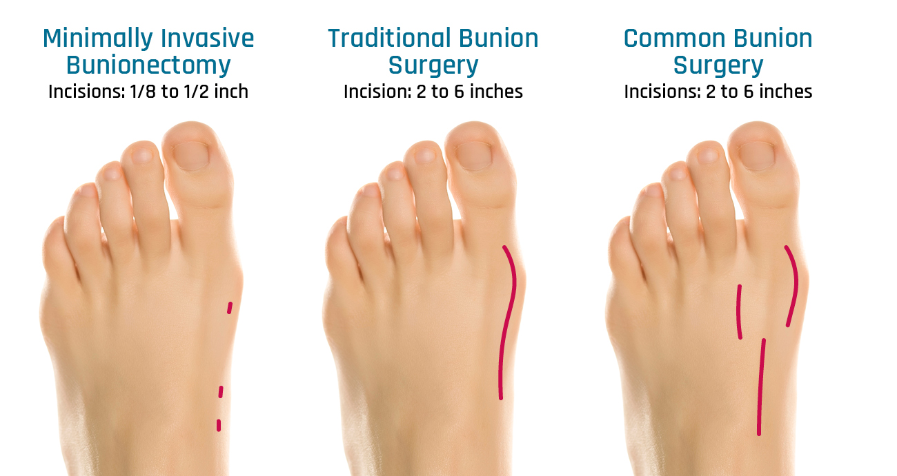 Minimally Invasive Bunion Correction Approach to Foot Wellness