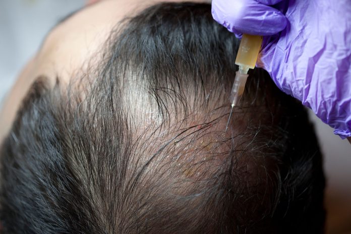 PRP hair treatment