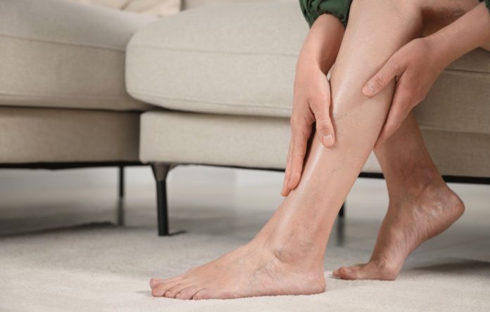 Varicose Veins Causes