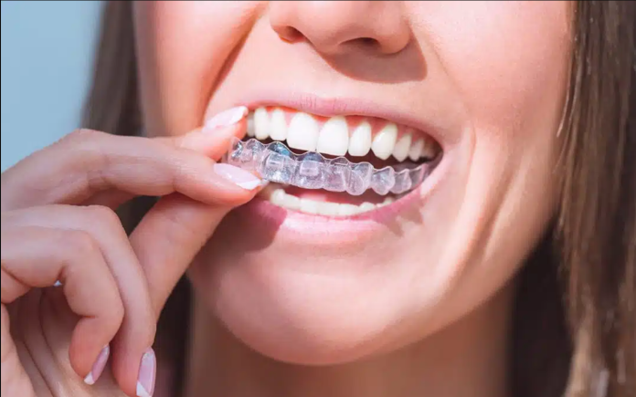 clear aligners