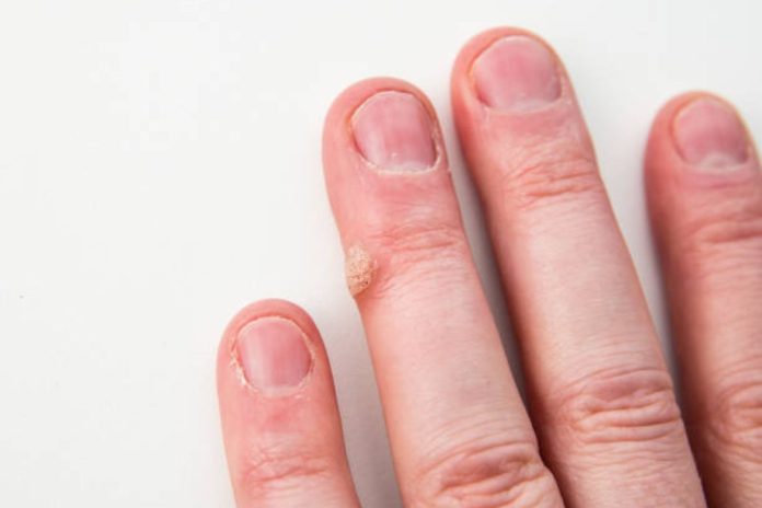 How Warts on Hands Differ A Visual Comparison