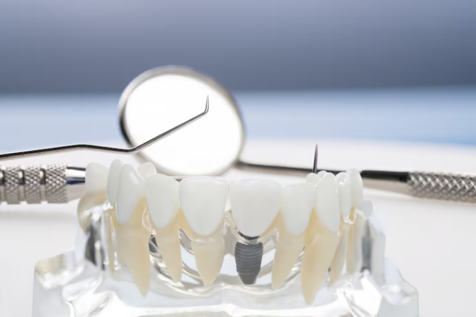 dental implants lillian al