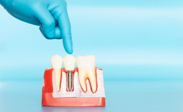 single tooth implant prairieville la