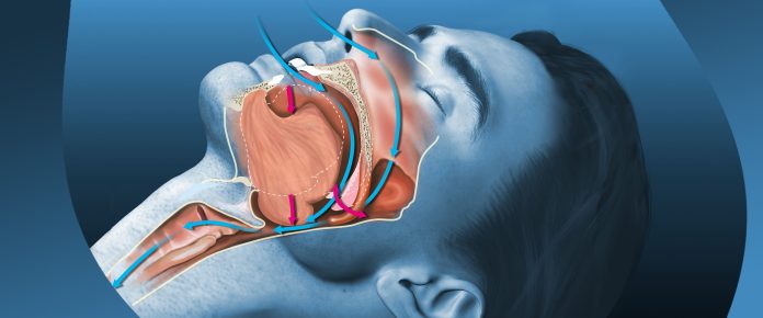 Snoring Treatment