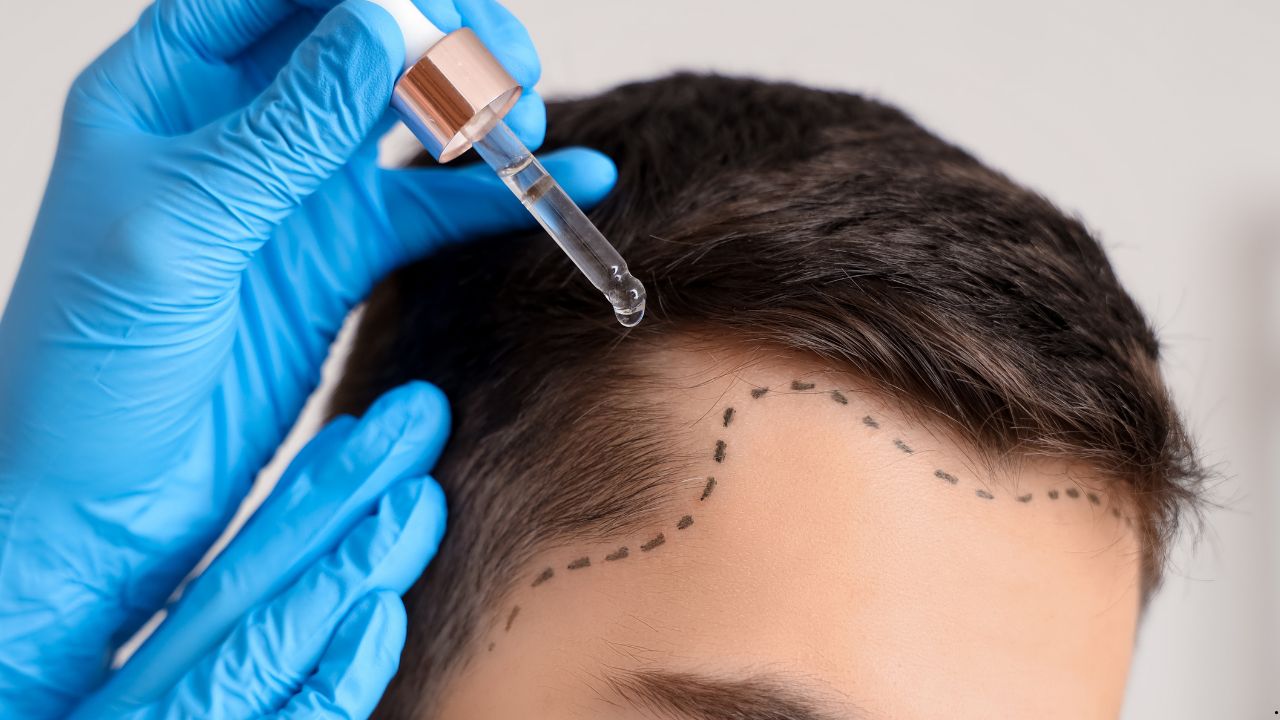 Addiction Recovery and Hair Transplantation: Restoring Health Inside and Out
